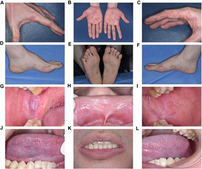 Lichenoid mucocutaneous reactions associated with sintilimab therapy in a non-small cell lung adenocarcinoma patient: case report and review